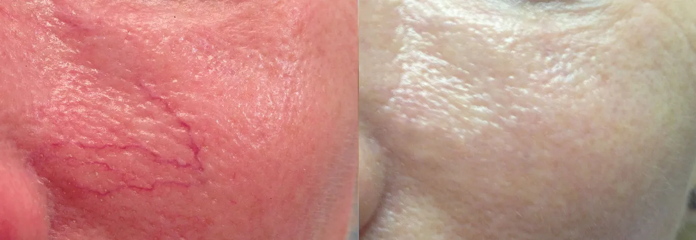 Red thread vein removal