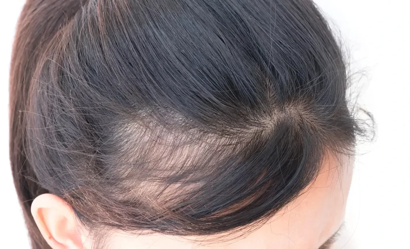 72% off Hairline Restoration!
