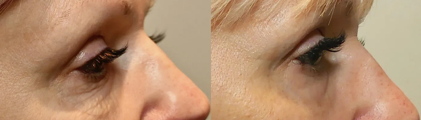 Under eye tightening