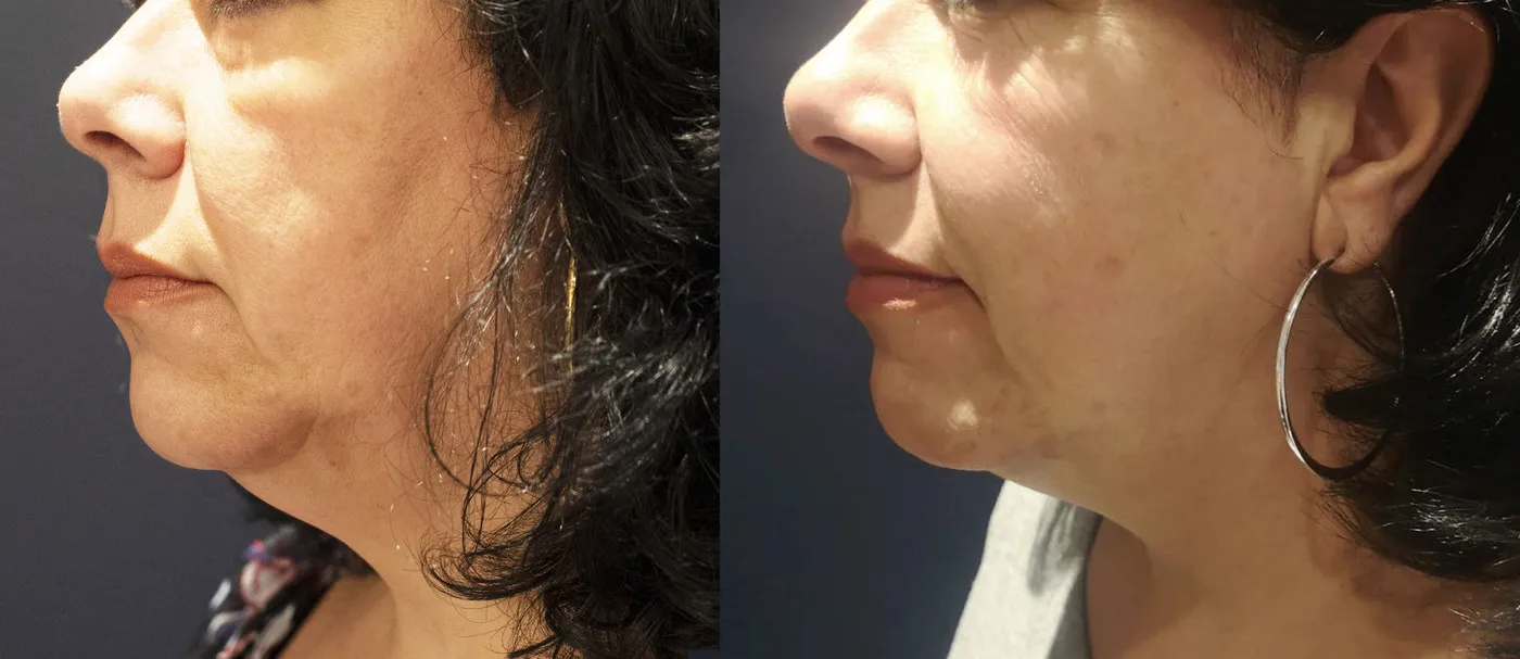 Skin tightening