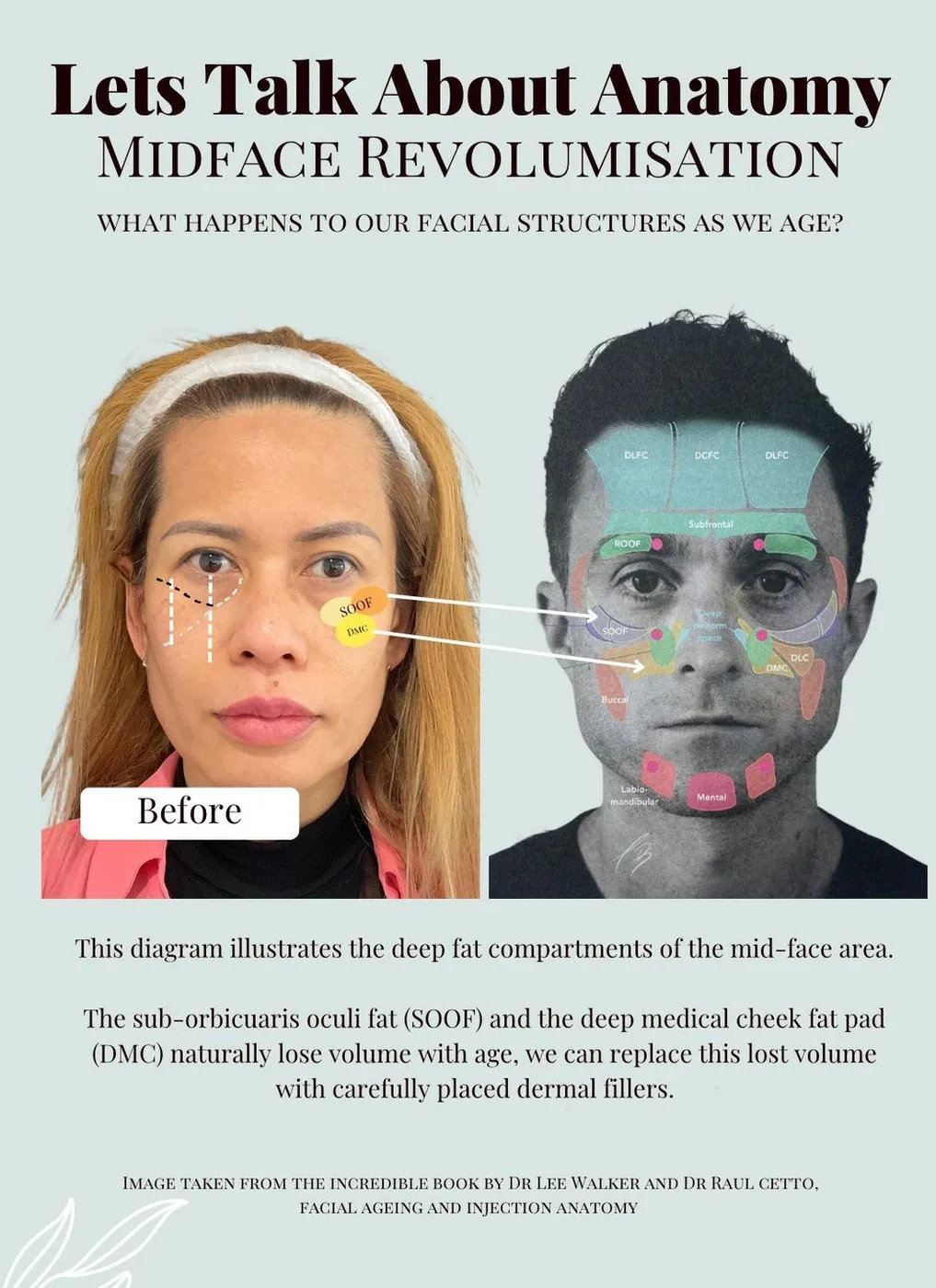 SE1 Medical Aesthetics London Midface Revolumisation