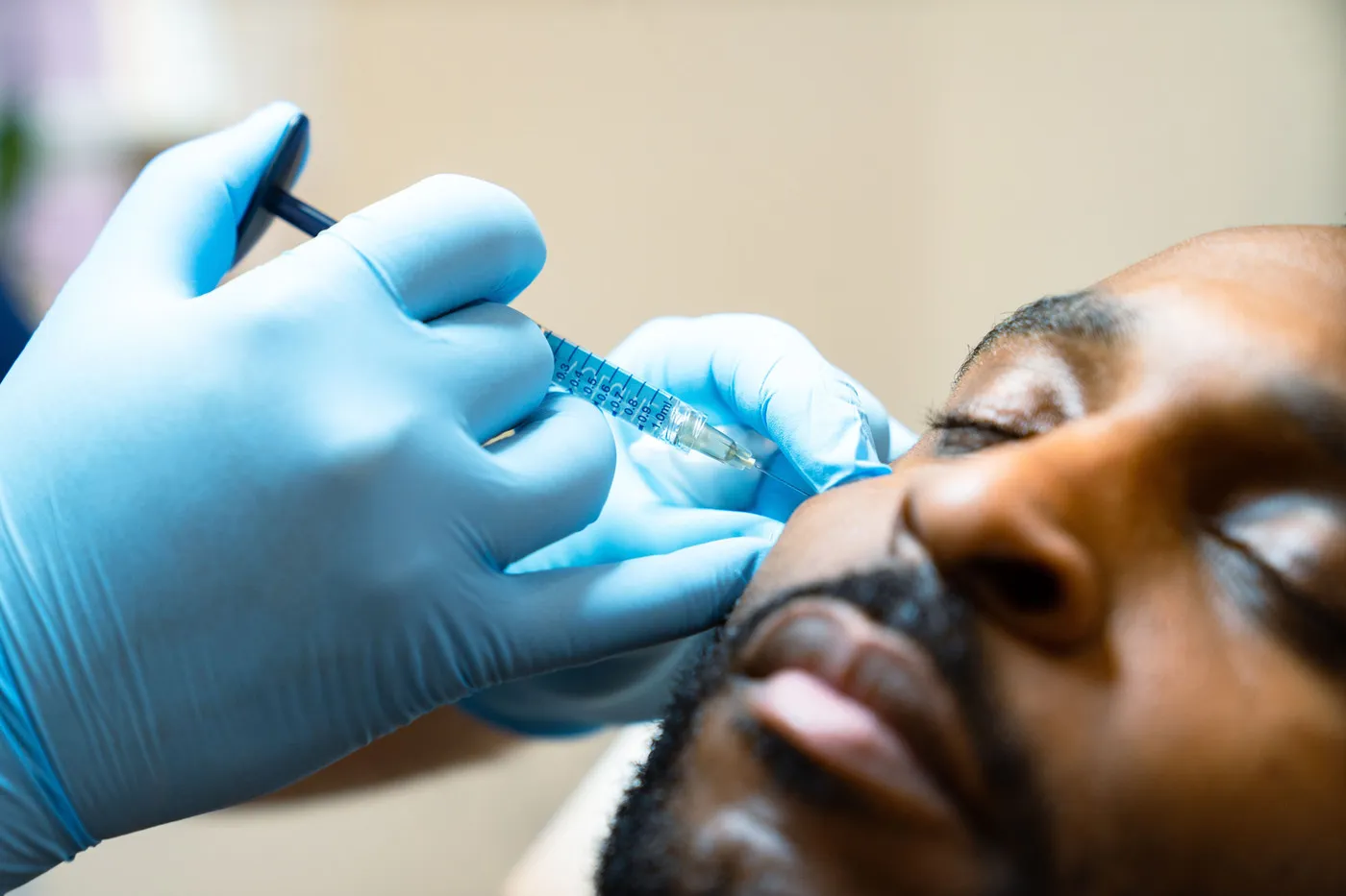 Dermal Filler treatment at SE1 Medical Aesthetics London