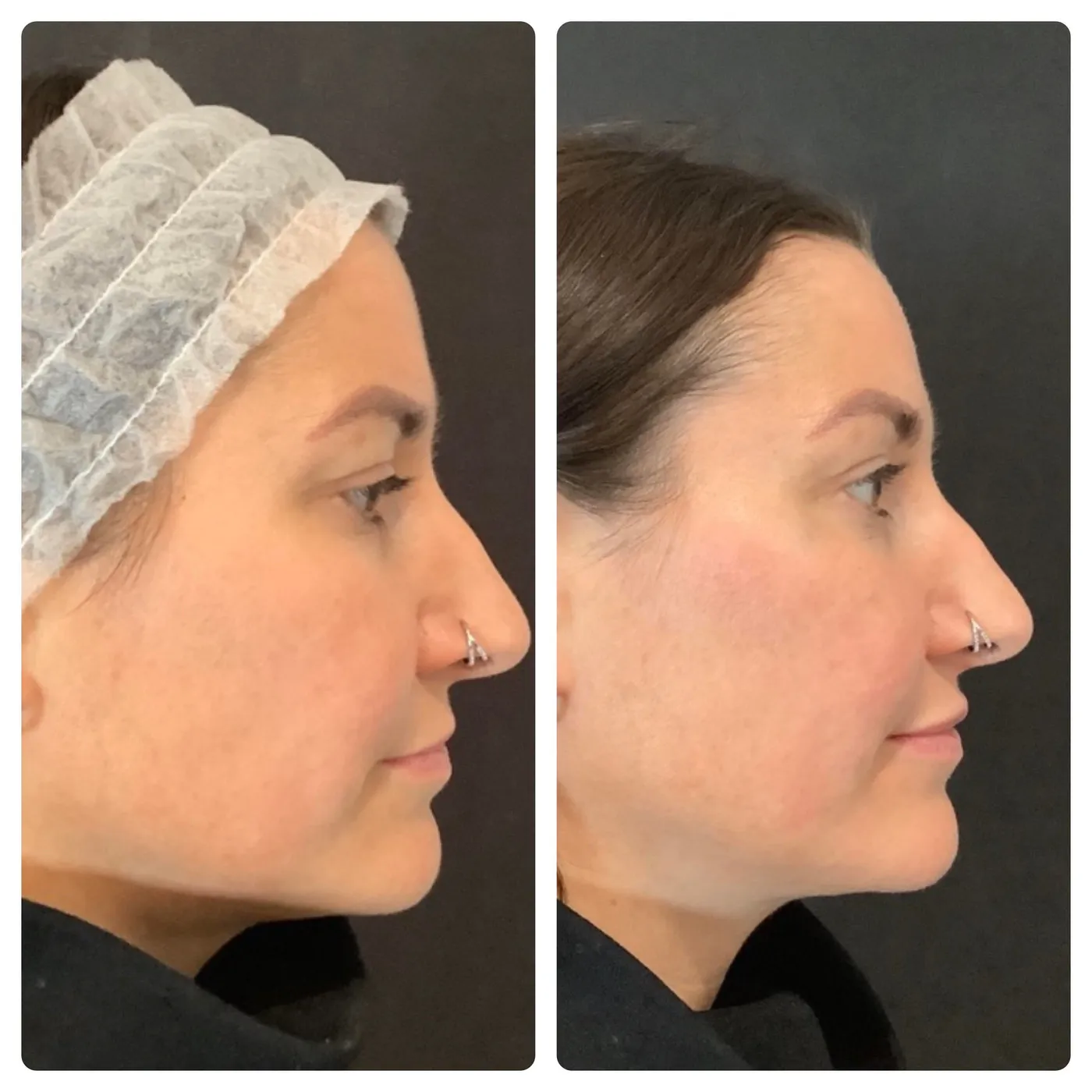 Facial Rejuvenation at SE1 Medical Aesthetics London