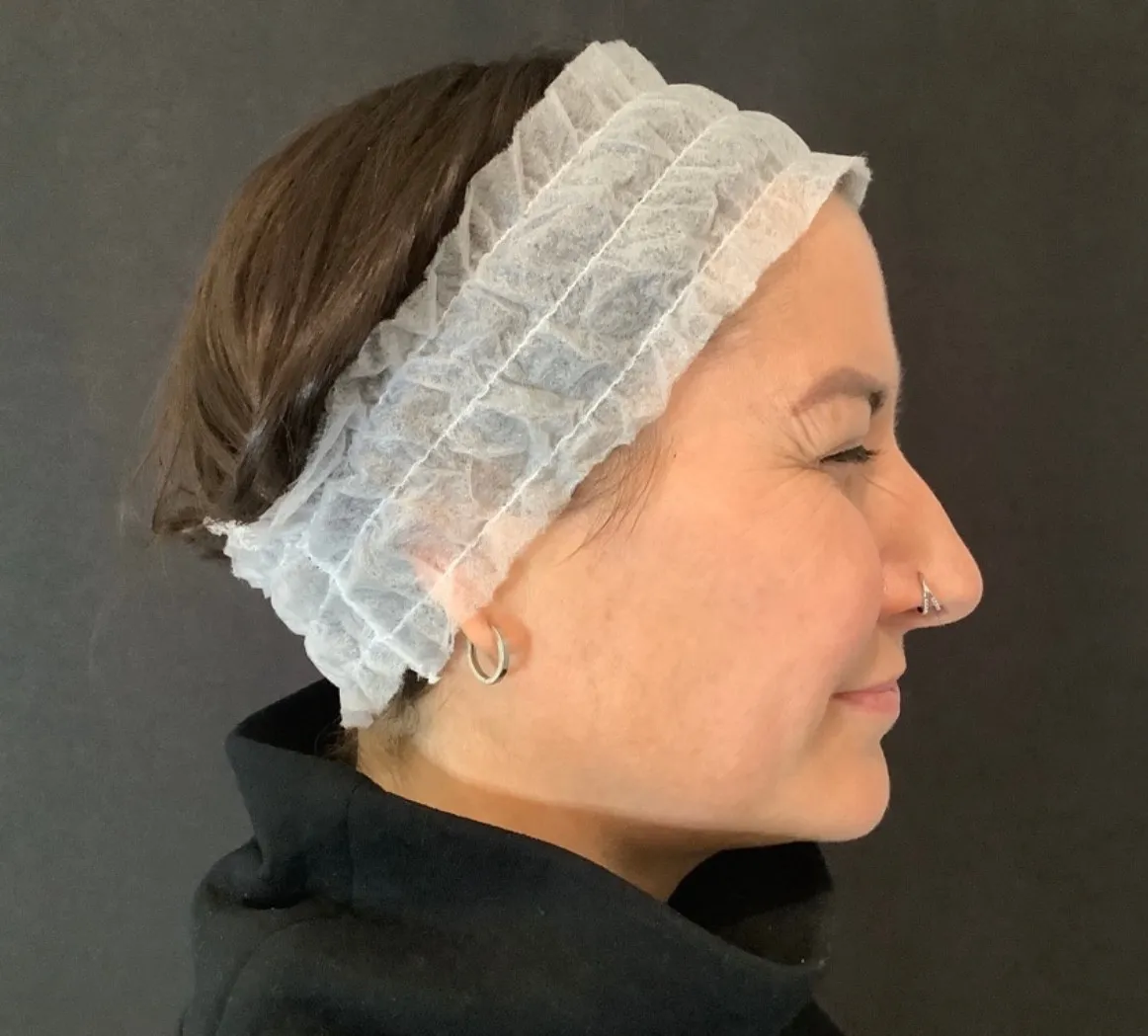 Facial Rejuvenation at SE1 Medical Aesthetics London