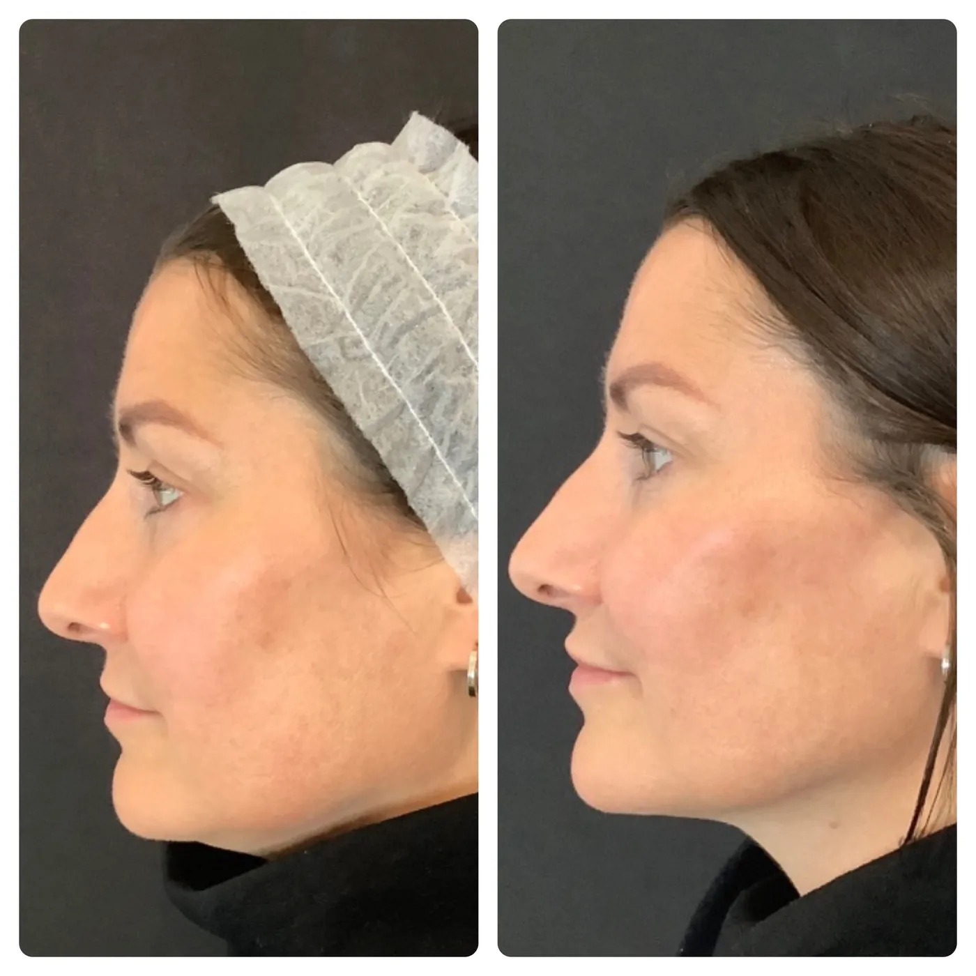 Facial Rejuvenation at SE1 Medical Aesthetics London
