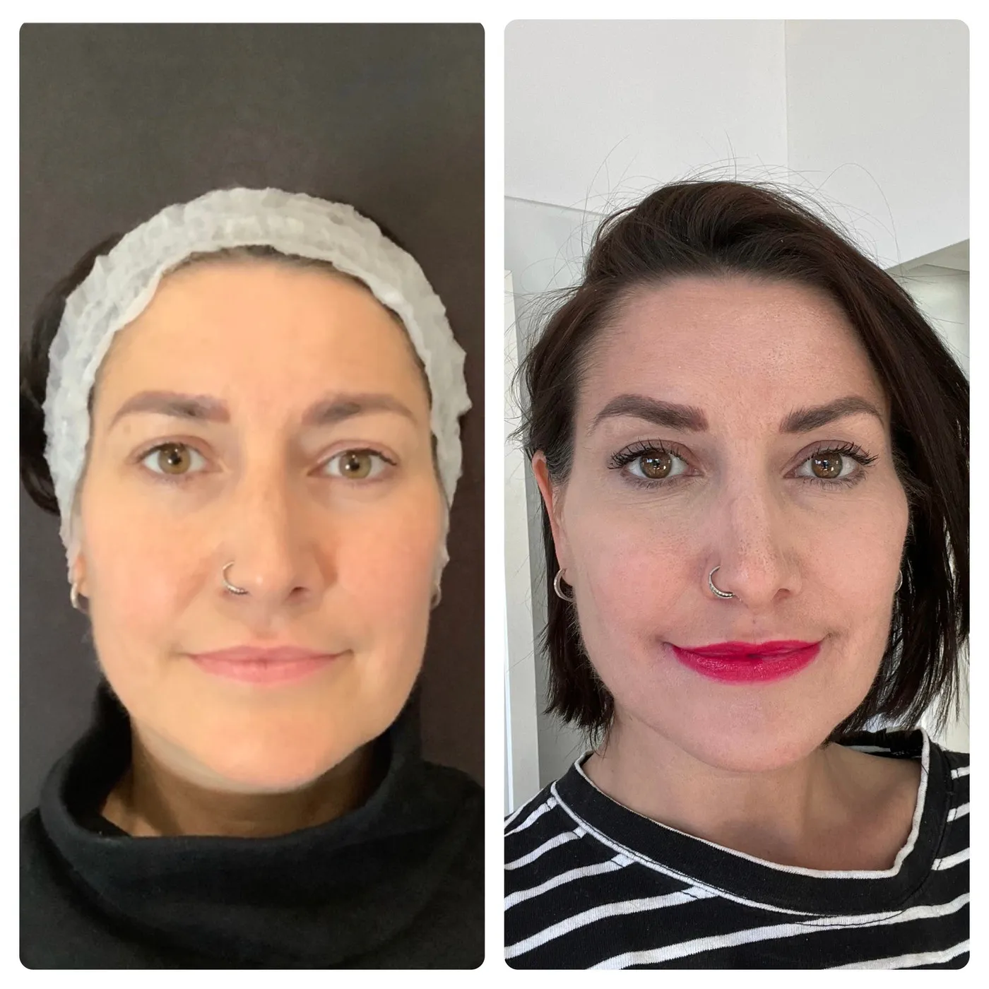 Facial Rejuvenation at SE1 Medical Aesthetics London