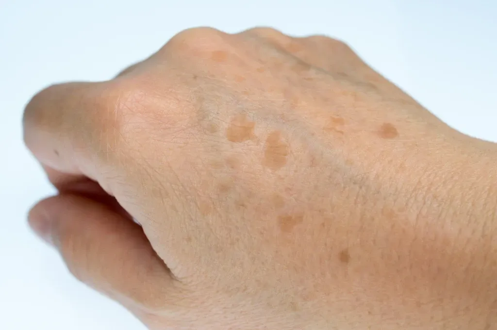 Hand rejuvenation with Dr Lorenzo