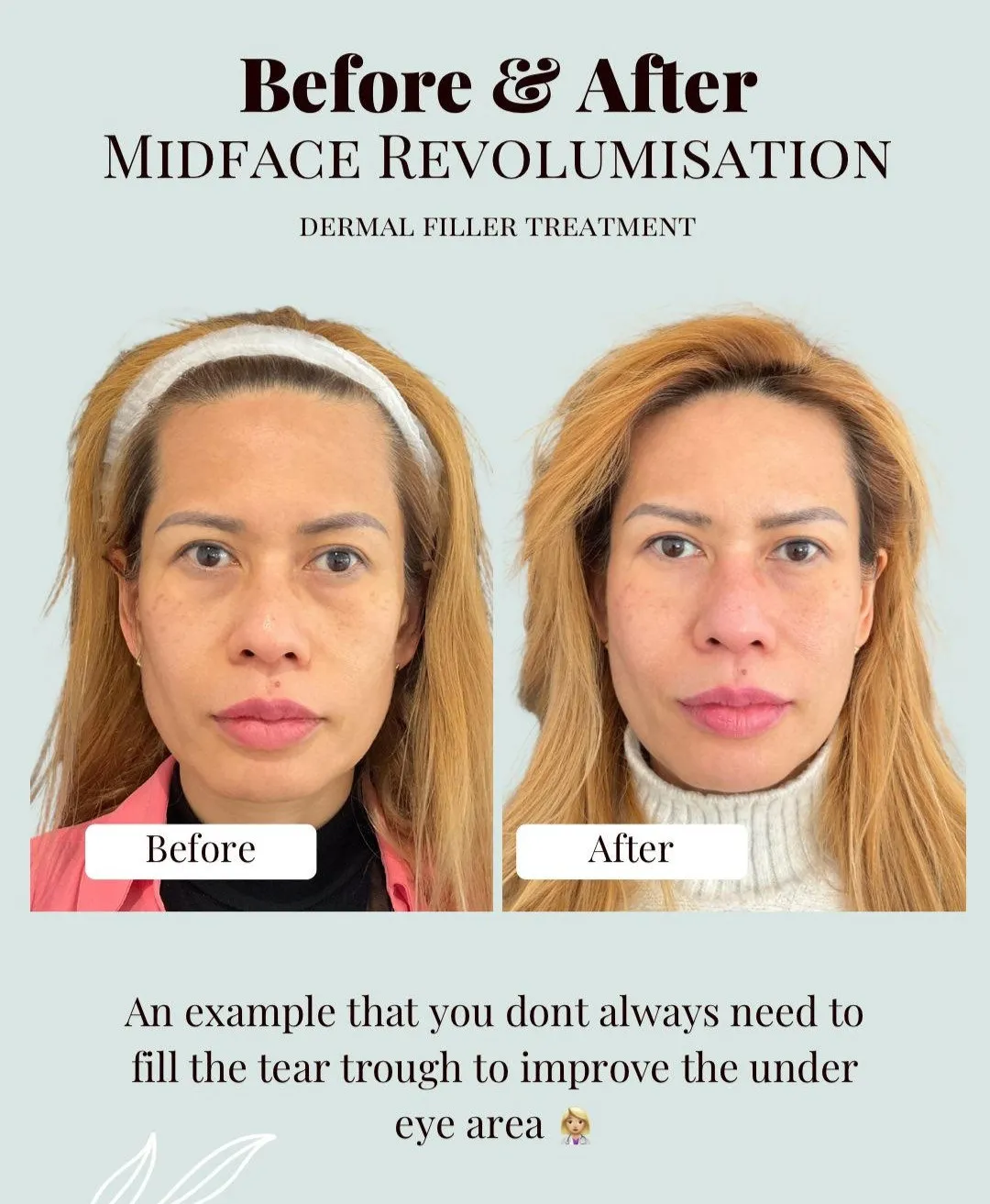 Cheek filler at SE1 Medical Aesthetics
