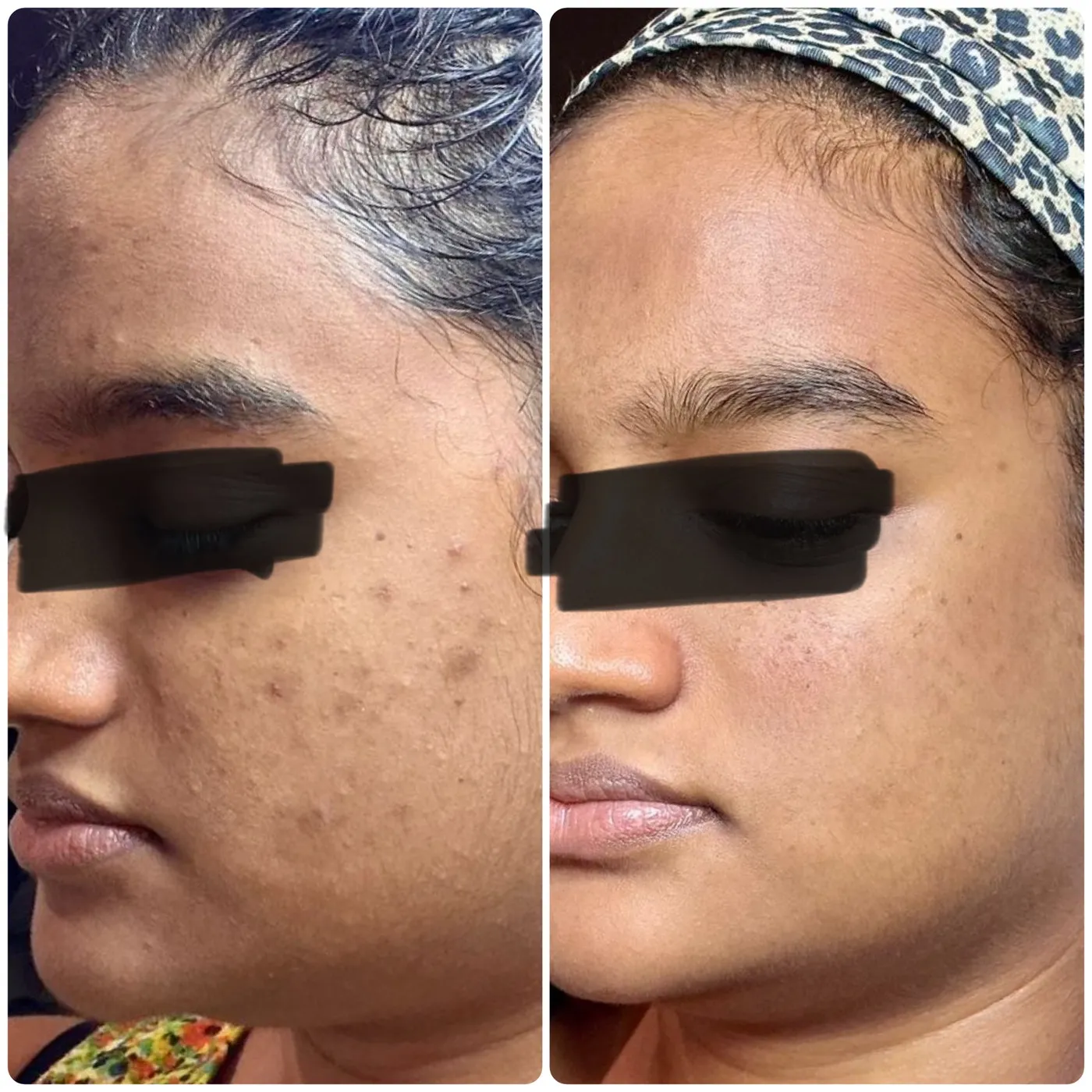 Microneedling