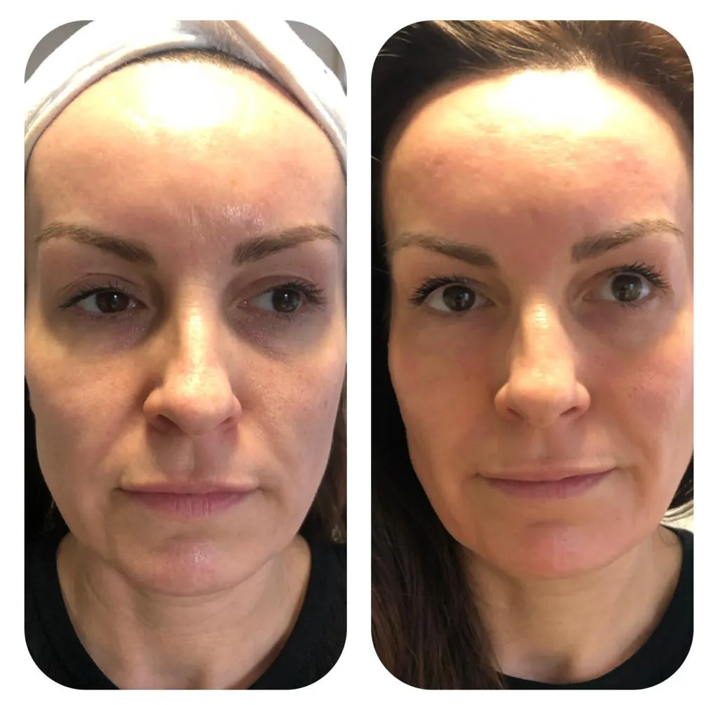 Before & after microneedling at SE1 Medical Aesthetics London