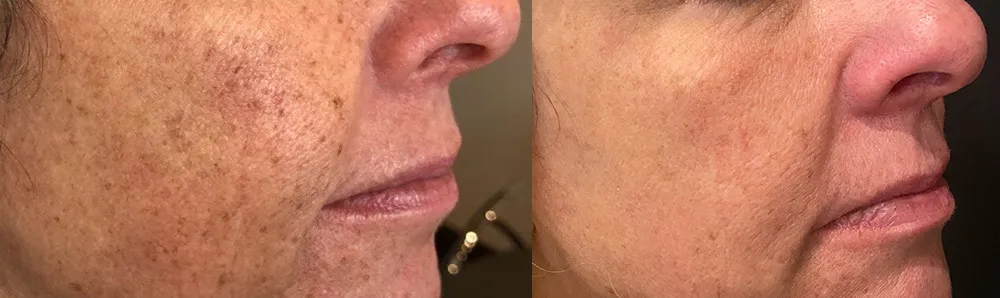 Lumecca IPL