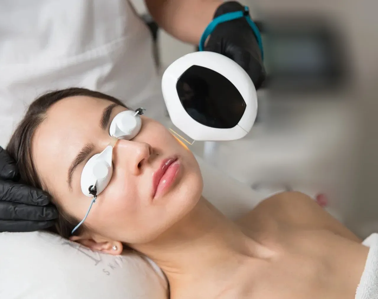 Lumecca IPL at SE1 Medical Aesthetics London