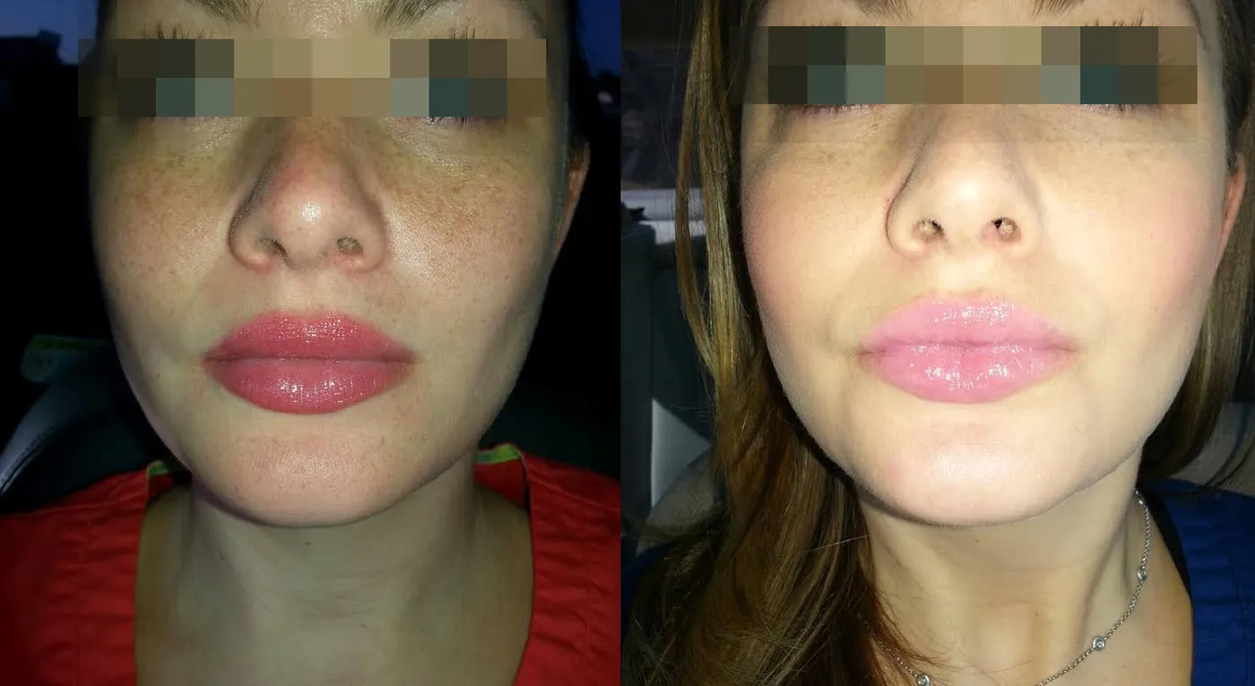 Lumecca IPL