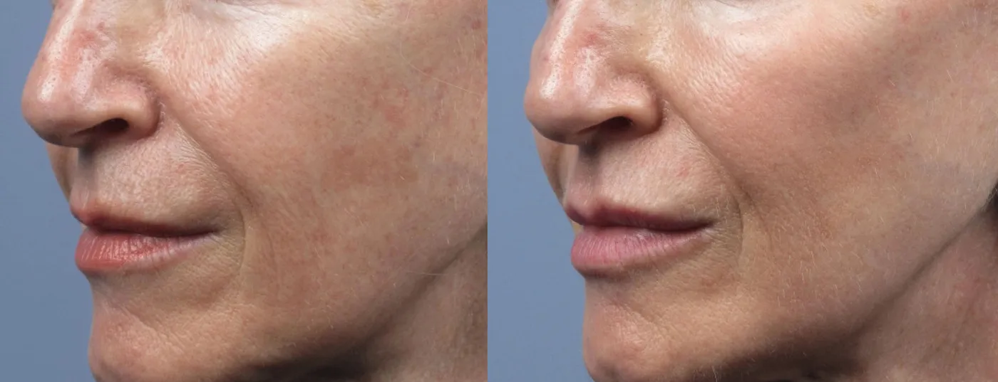 Lumecca IPL