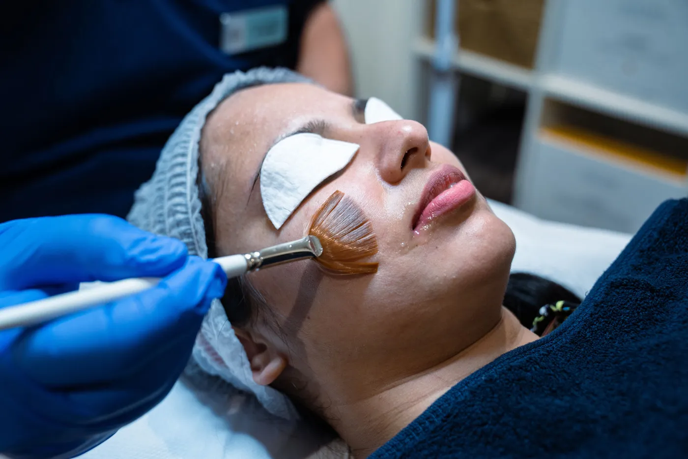 SE1 Medical Aesthetics London Chemical Peel