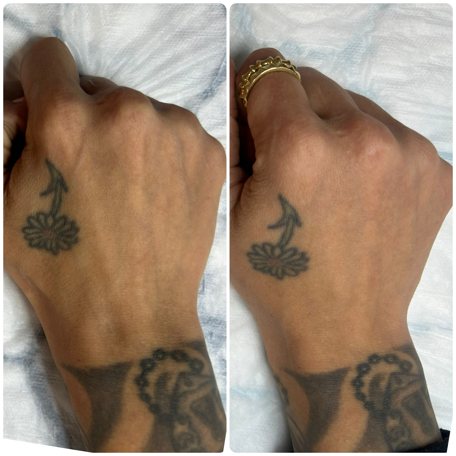 B-FAB® Hand Rejuvenation