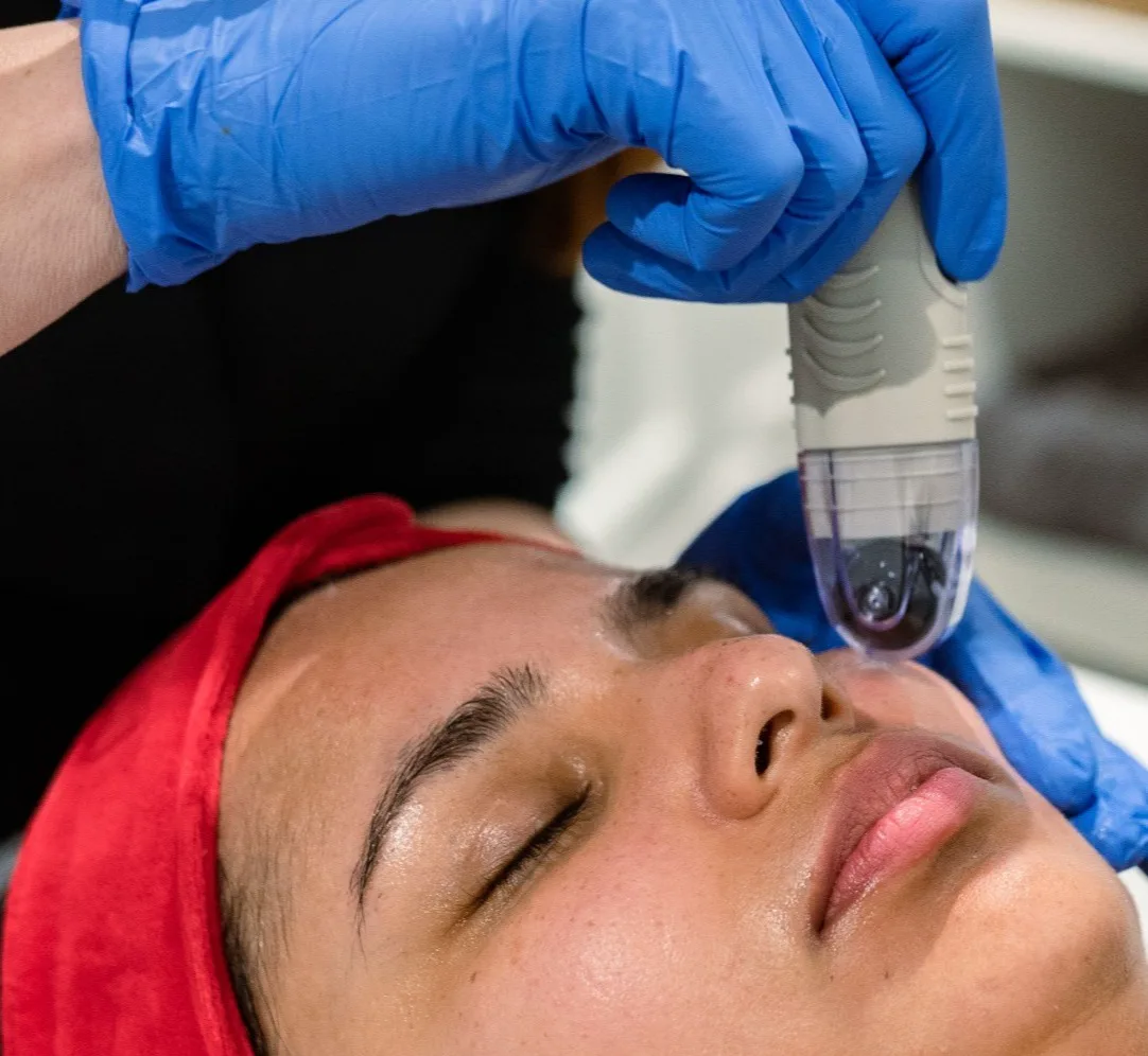 DermaFrac microneedling facial treatment