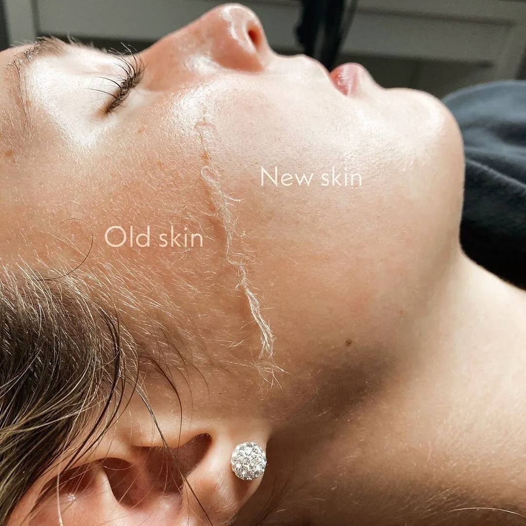Dermaplaning facial treatment