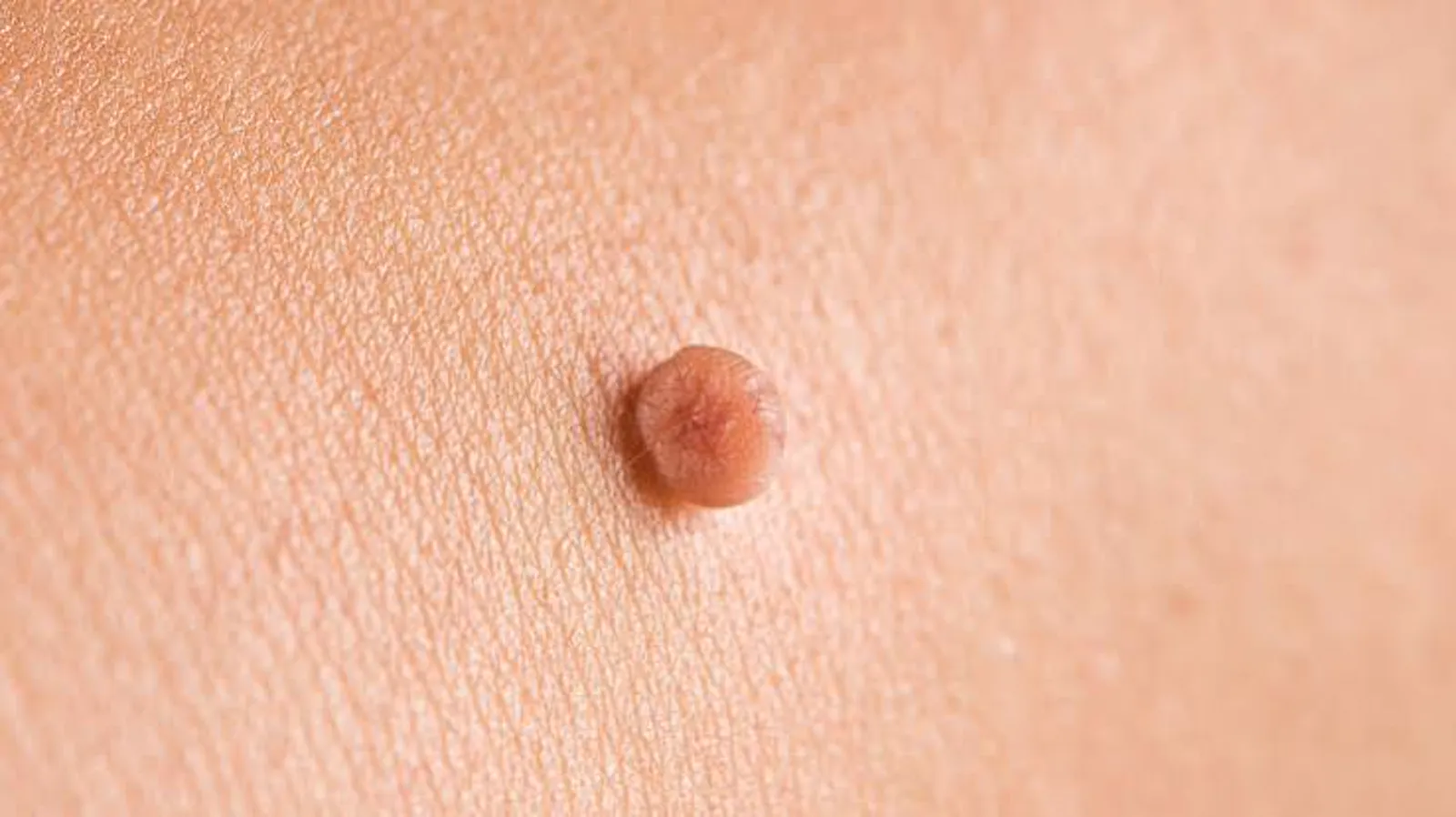 Close-up clinical example of a skin tag