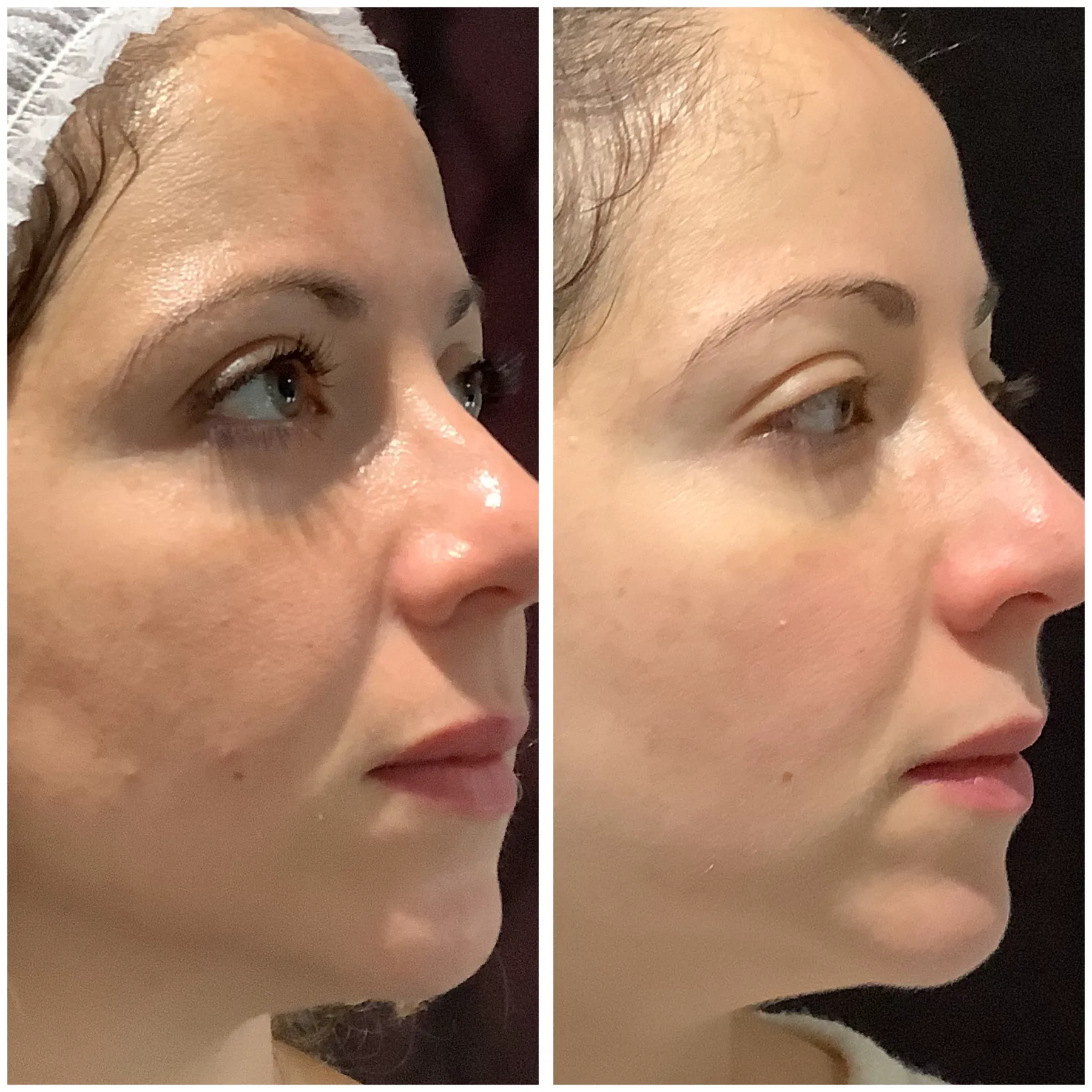 DermaFrac before and after profile result
