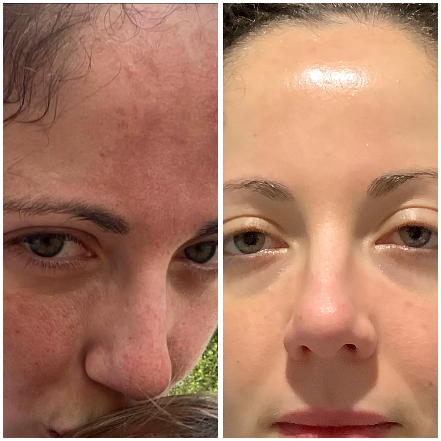 DermaFrac before and after result showing facial skin texture