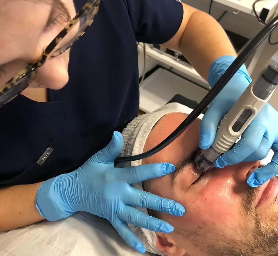 DermaFrac® treatment