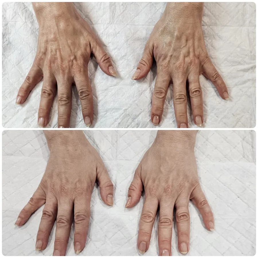 B-FAB® Hand Rejuvenation