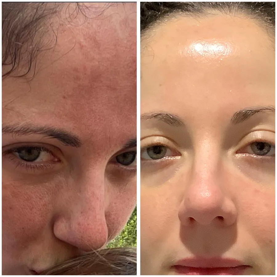 DermaFrac® Microneedling
