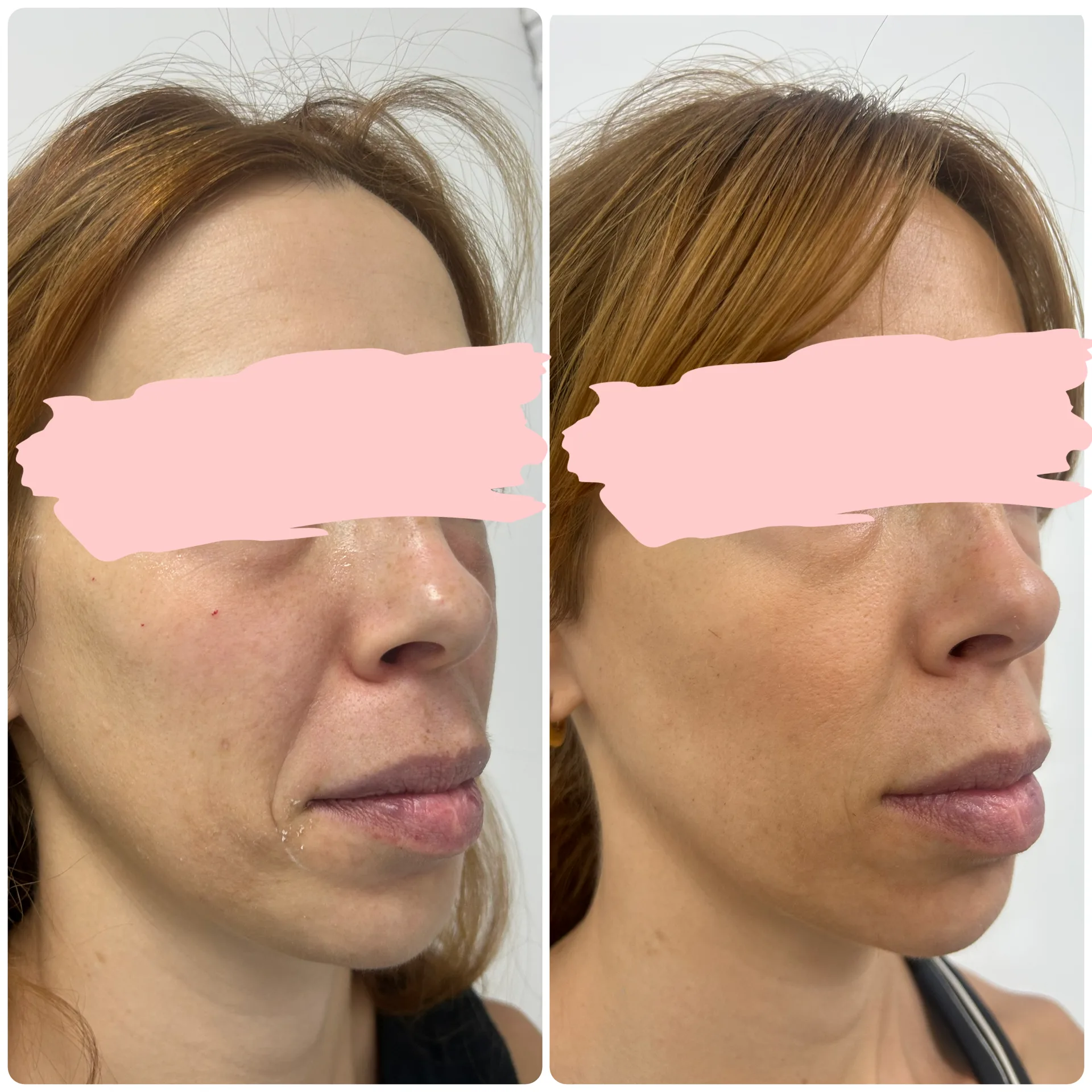 Erelle™ CMC Bio-Scaffold Filler