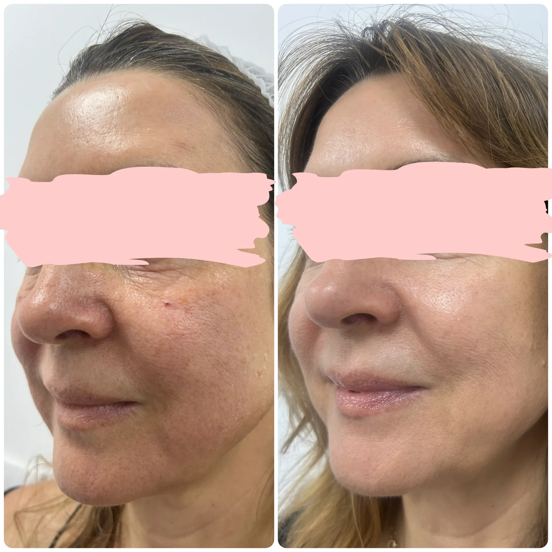 Erelle™ CMC Bio-Scaffold Filler