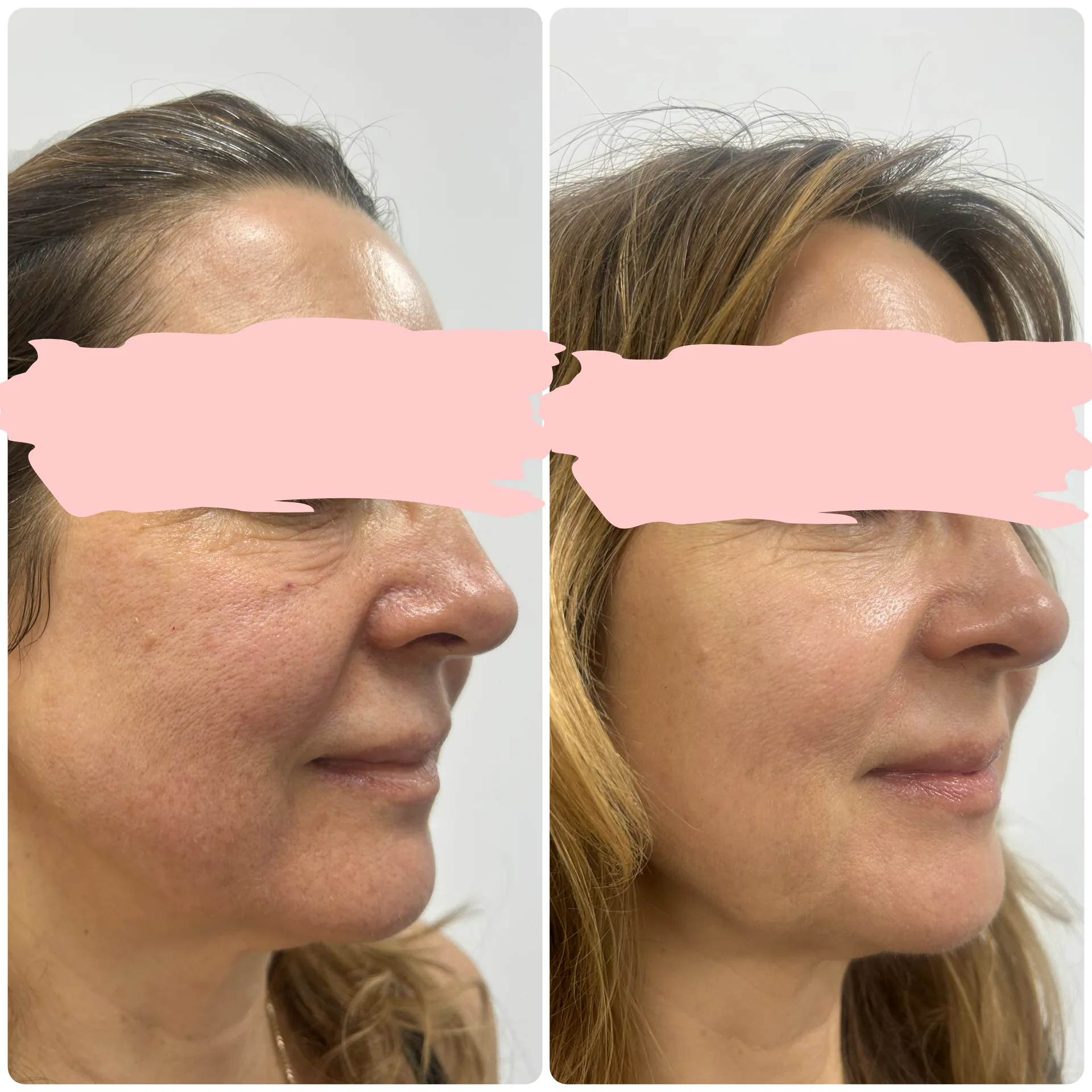 Erelle™ CMC Bio-Scaffold Filler before and after