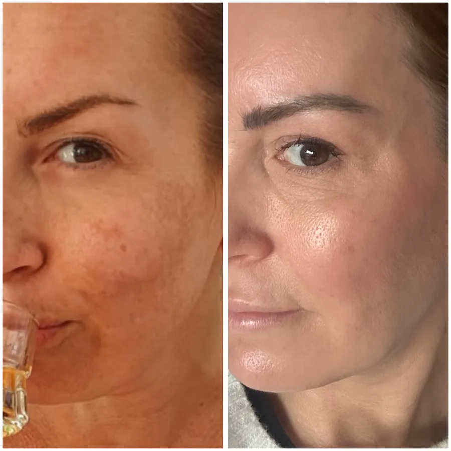 Morpheus8, DermaFrac®, Filler