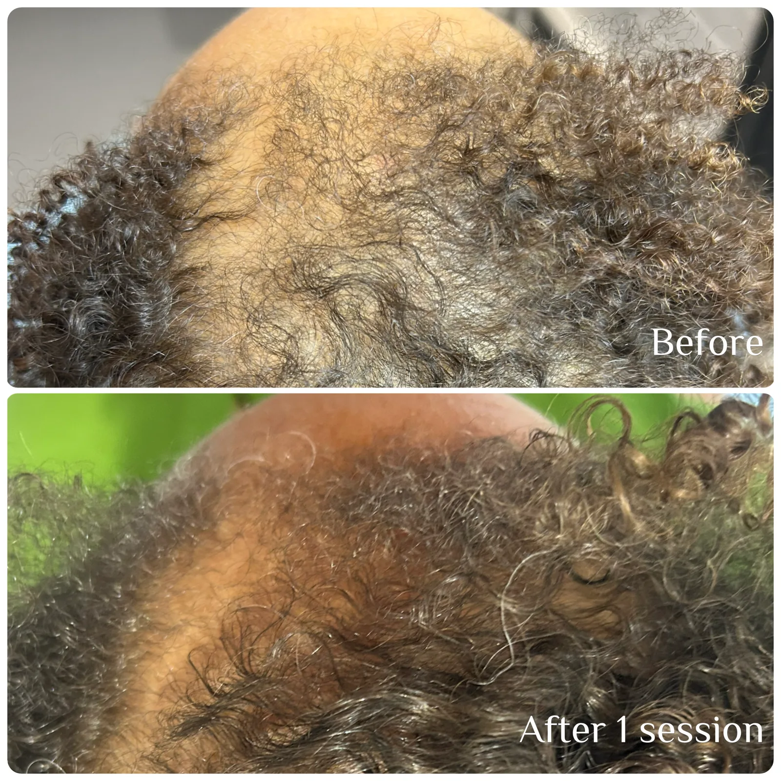 Hair Restoration