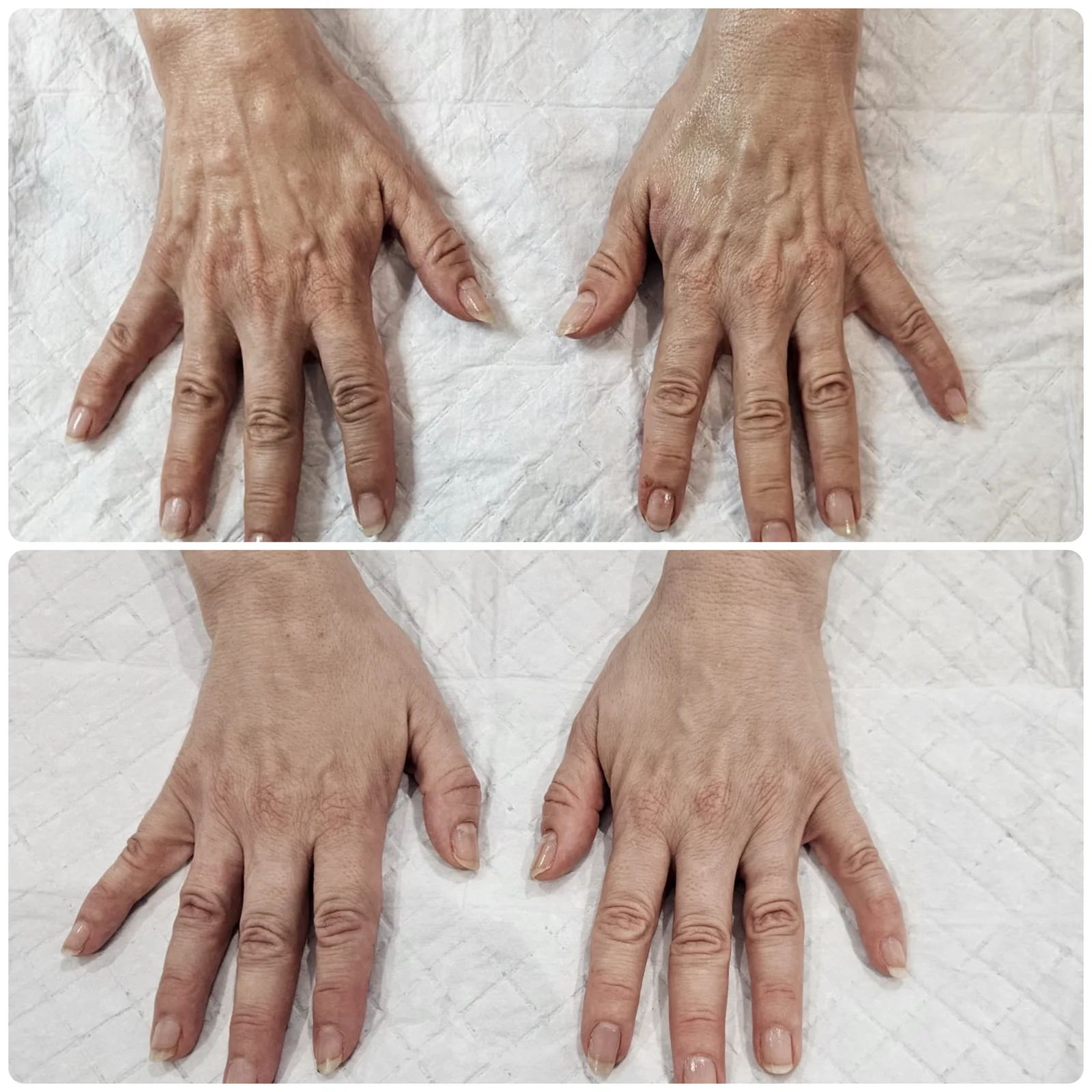 Before and after hand rejuvenation result