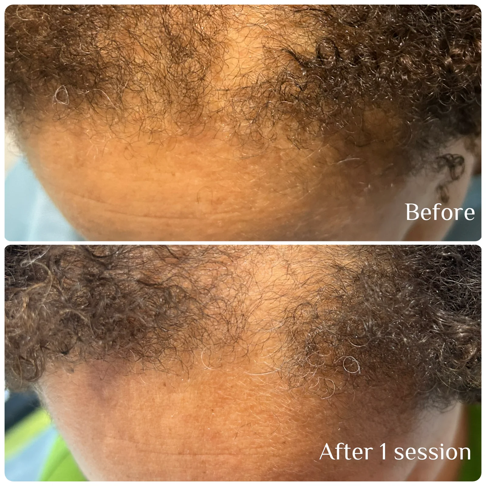 Hair Restoration