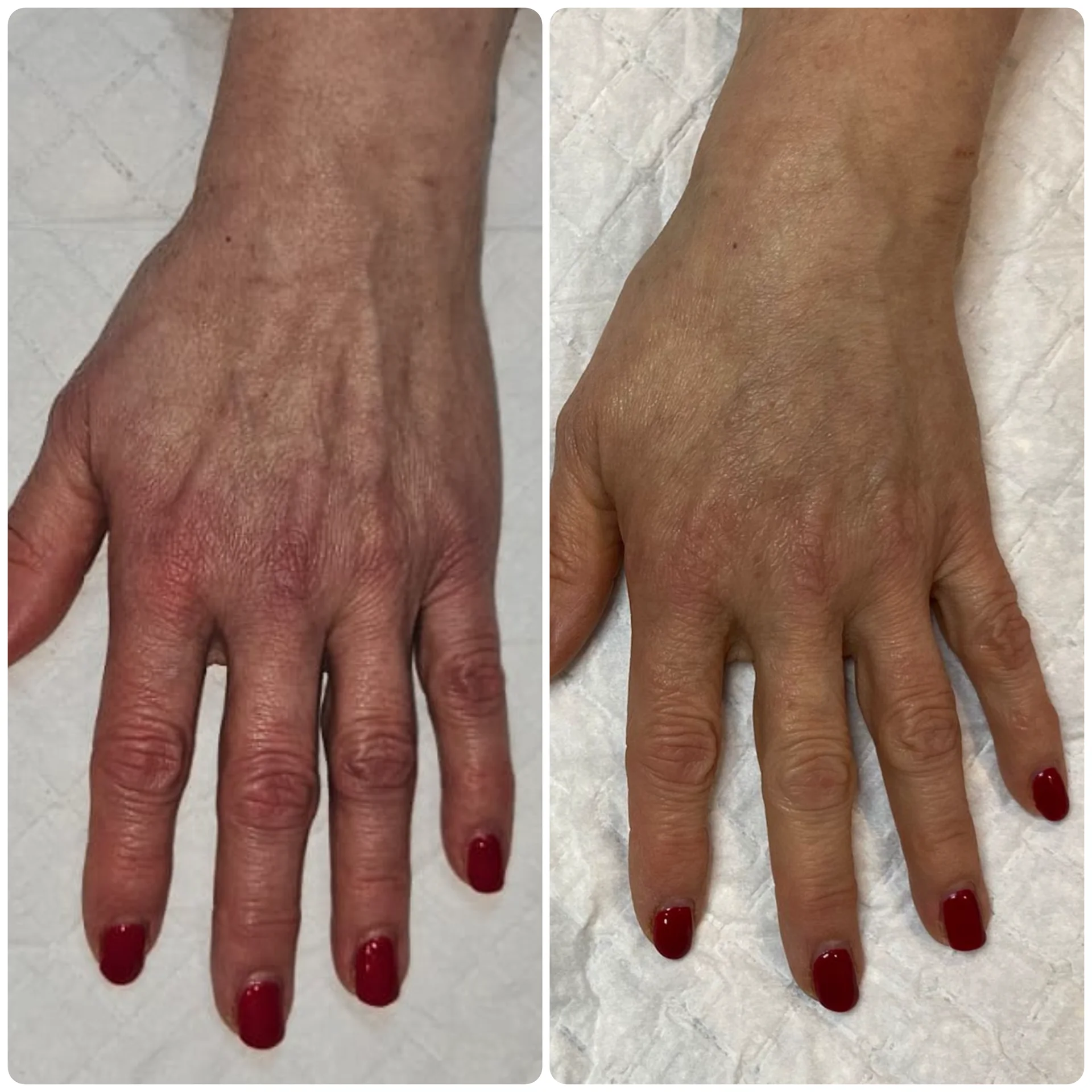 Hand Rejuvenation treatment