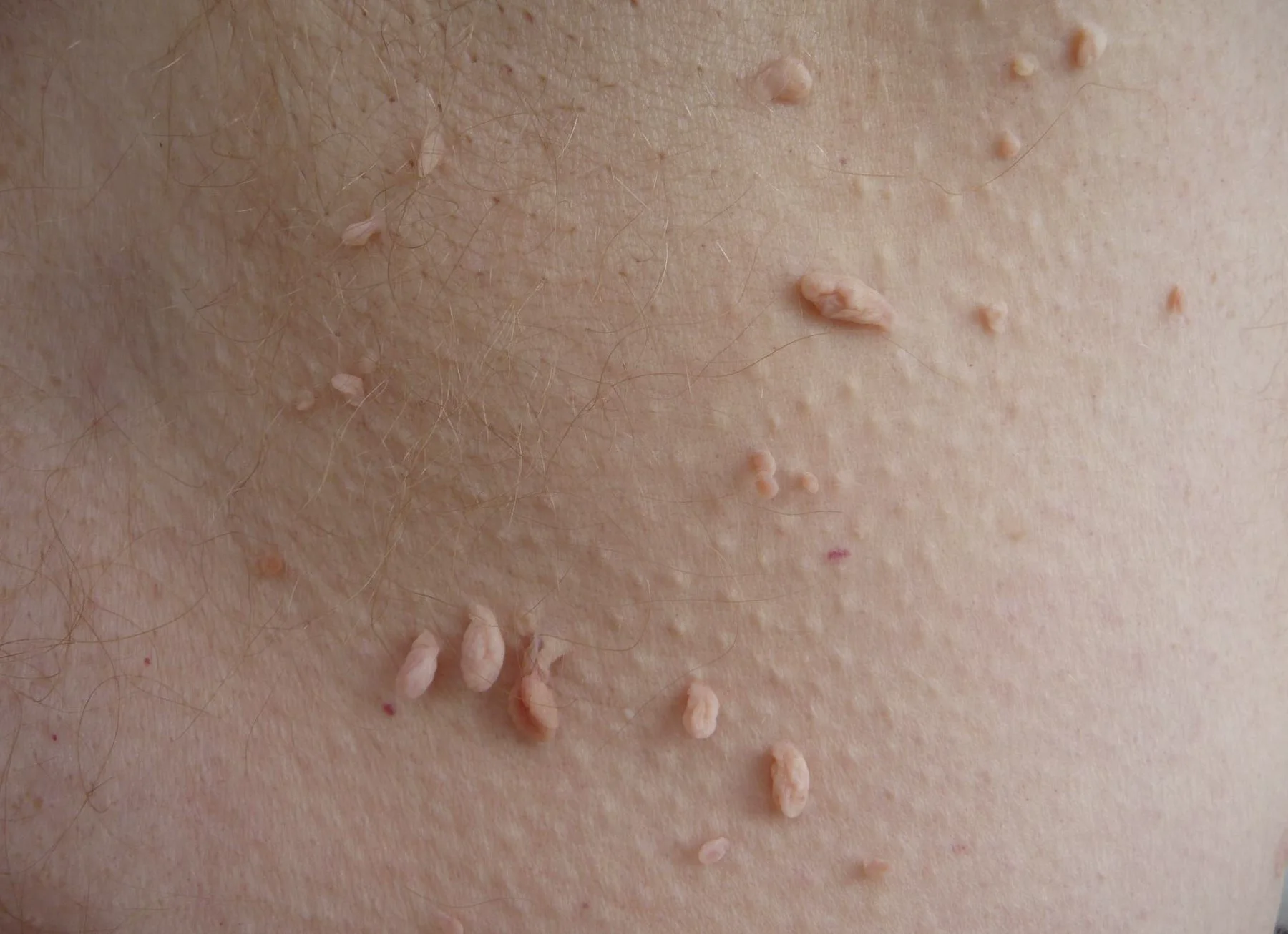 Skin Tag Removal